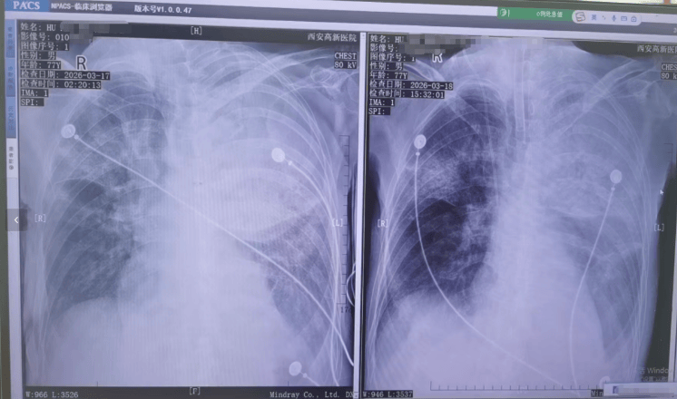 世界杯真钱开户 _男子在陕西一景区套圈套中鹦鹉带回家饲养世界杯真钱开户 ，鹦鹉死后父亲感染“鹦鹉热”，“整个肺部全白了”；医生：潜伏期5至14天，早期表现类似流感
