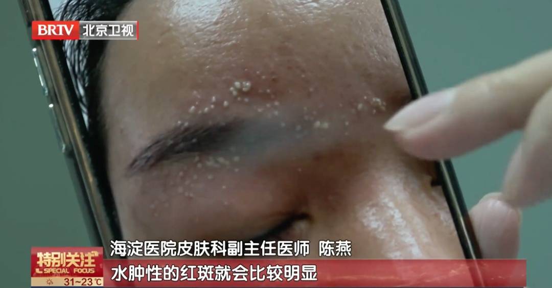 皇冠信用_北京已有人中招皇冠信用，千万不能拍，毒液堪比硫酸，会毁容——